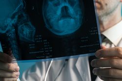 Doctor examining skull X-ray film