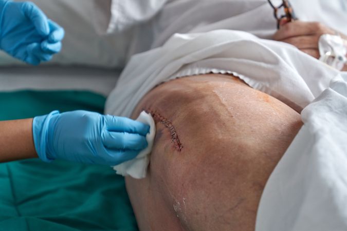 Unrecognizable nurse wiping leg of patient with stitches