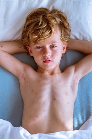 Boy with chickenpox holding hands behind head