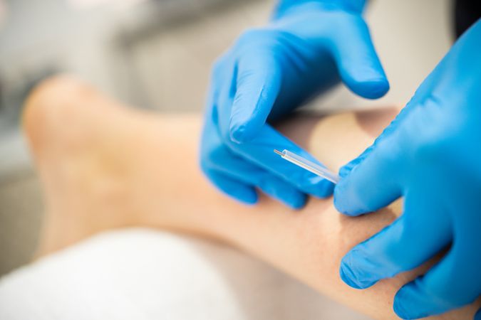 Physiotherapist wearing blue latex gloves doing dry needling
