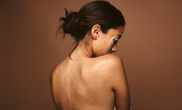 Woman with skin disease and her bare back facing the camera