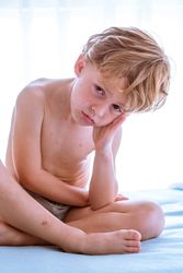 Boy with chickenpox sitting on bed