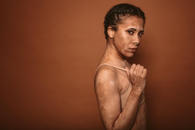 Young woman with vitiligo disease standing against brown background