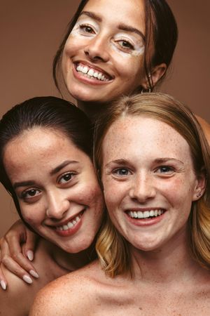 Smiling women with vitiligo, acne, and freckles