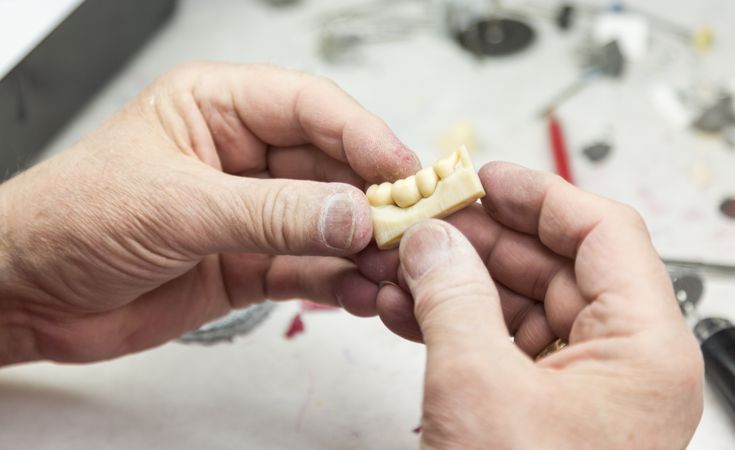 Dental Technician Working On 3D Printed Mold For Tooth Implants