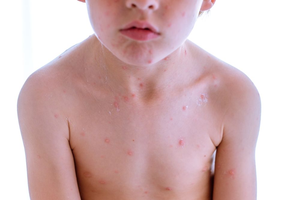 Crop child with varicella blisters