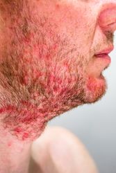 Man with seborrheic dermatitis in the beard area