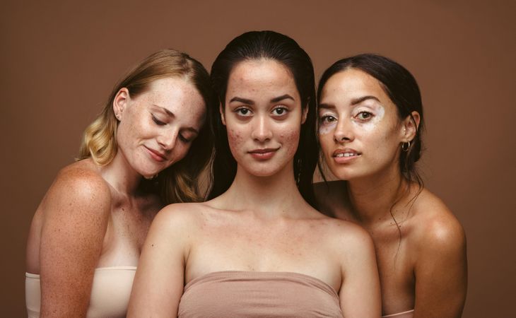 Women with hormonal acne, vitiligo, and freckles