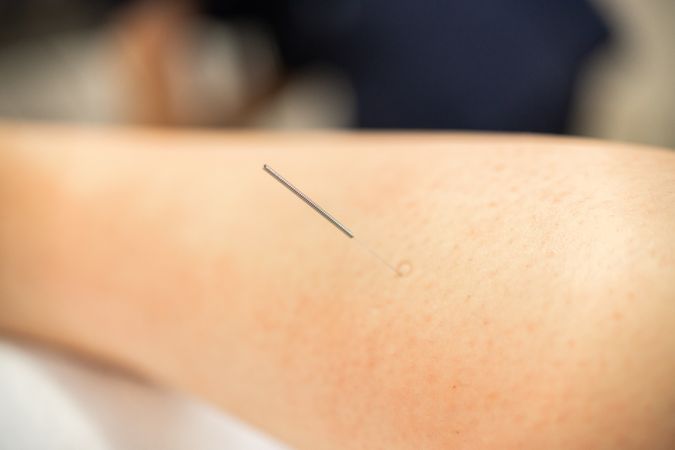 Acupuncture needle in patient’s