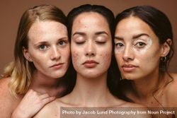 Beauty models with real skin conditions 5nVp85