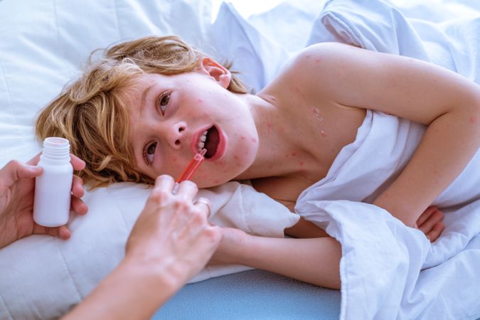 Child with chickenpox taking cure