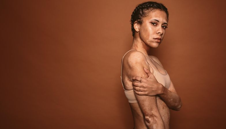 Woman with vitiligo standing on brown background with copy space
