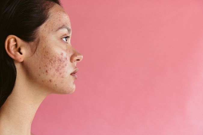 Close up of one side of woman’s face with hormonal acne