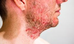 Man with seborrheic dermatitis in the beard area