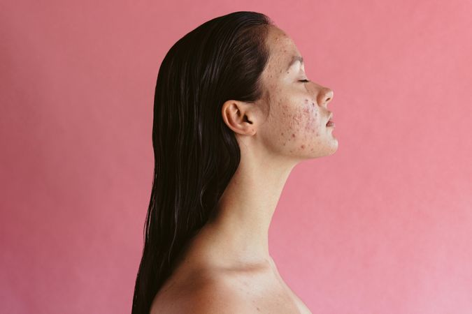 Side view portrait of woman with acne inflammation on pink background