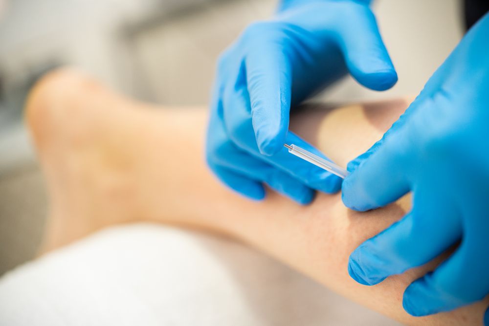 Hands in blue latex gloves doing dry needling