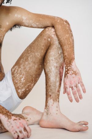 Cropped image of a topless man with vitiligo sitting on floor against light background