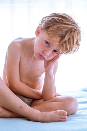 Boy with chickenpox sitting on bed