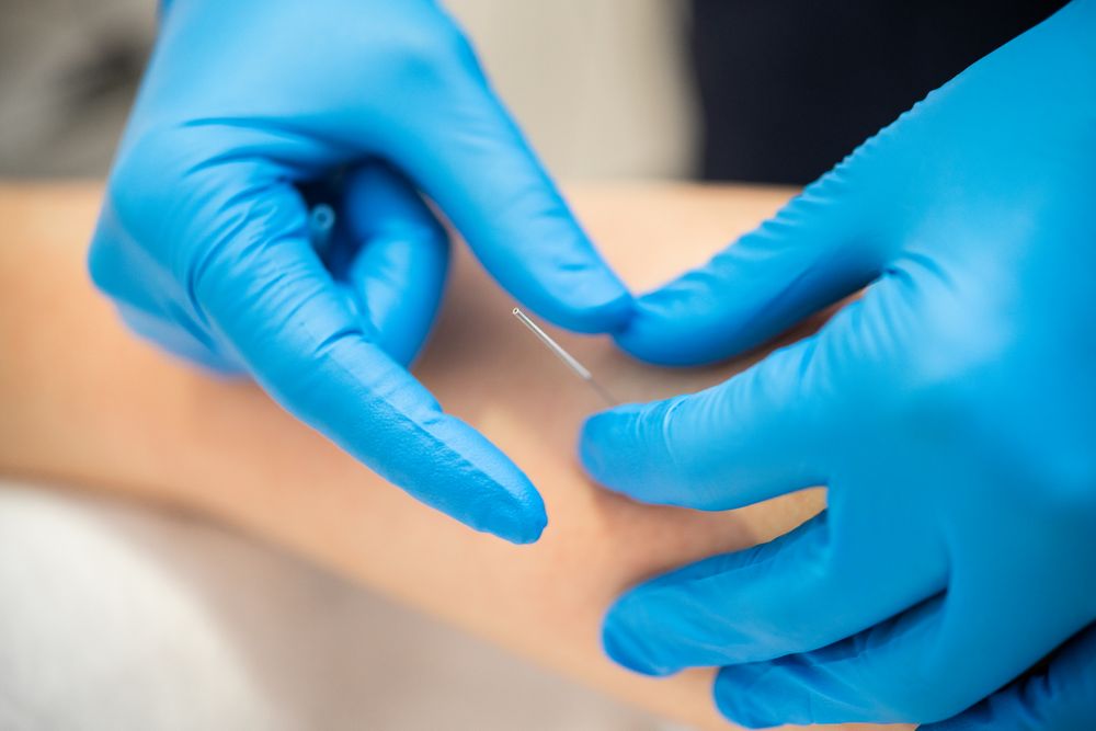 Physio in latex gloves doing dry needling on patient