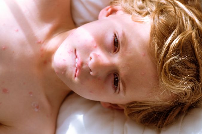 Ill boy with chickenpox biting lip