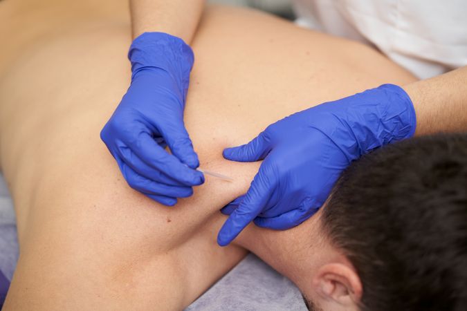 physiotherapist treating an overload with dry needling