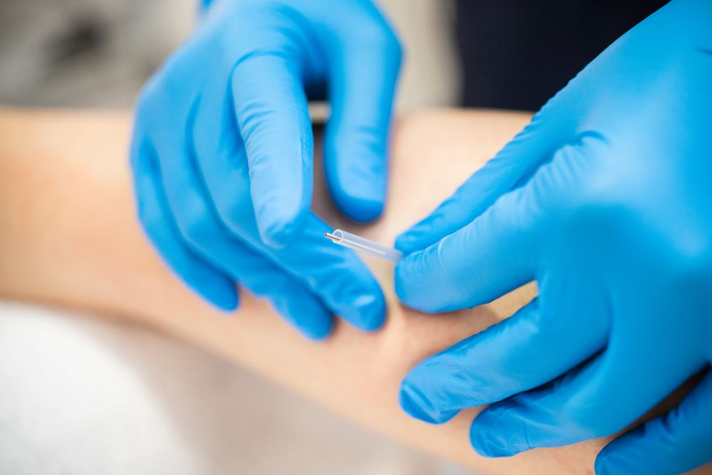 Physiotherapist in latex gloves doing dry needling on patient