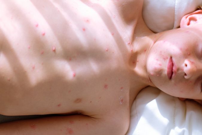 Crop boy with chickenpox blisters
