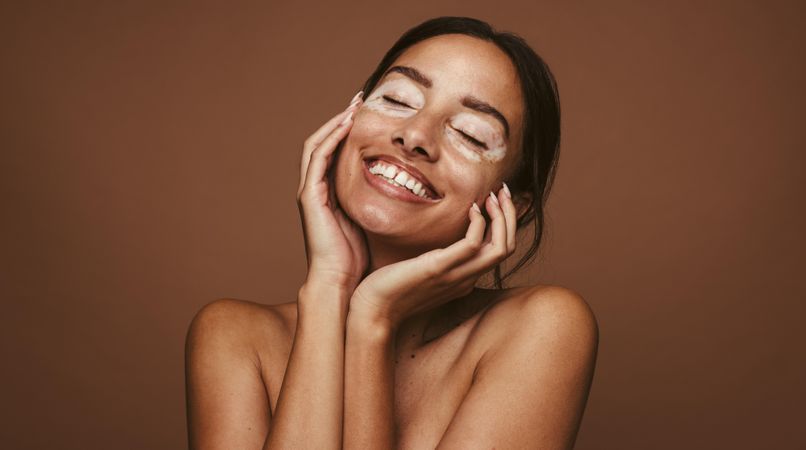 Smiling young woman with vitiligo