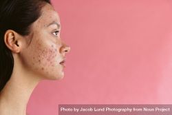 Close up of one side of woman’s face with hormonal acne 5ojyQ0