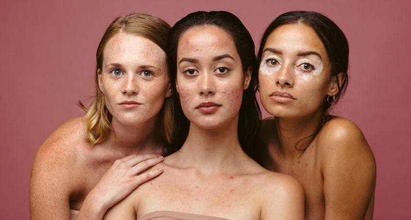 Portrait of three serious women with skin imperfections