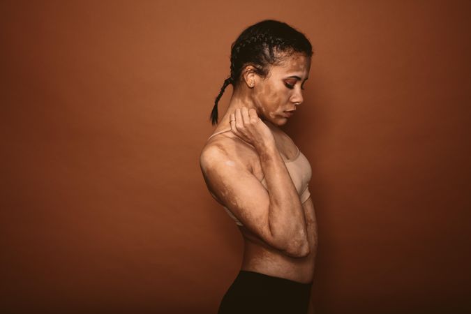 Young woman with vitiligo standing against brown background