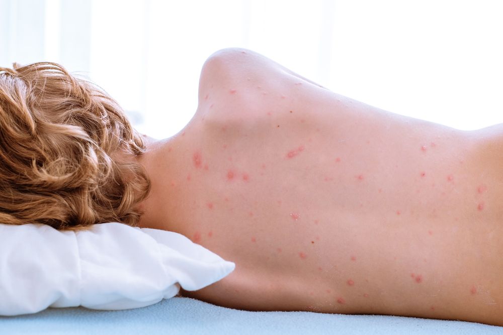 Anonymous boy with varicella disease on bed