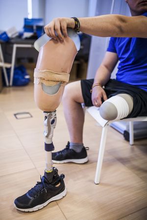 amputated young man testing the new leg prosthesis