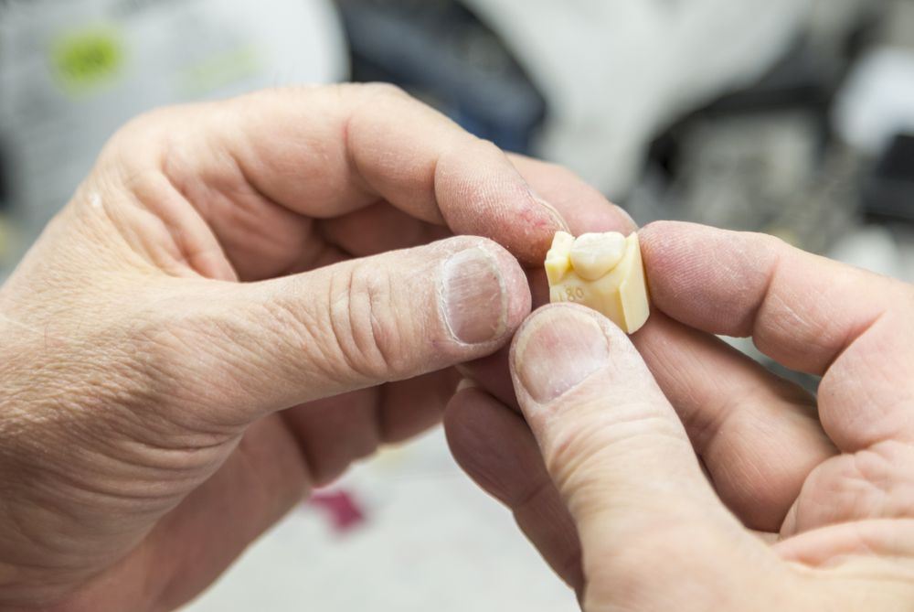 Dental Technician Working On 3D Printed Mold For Tooth Implants