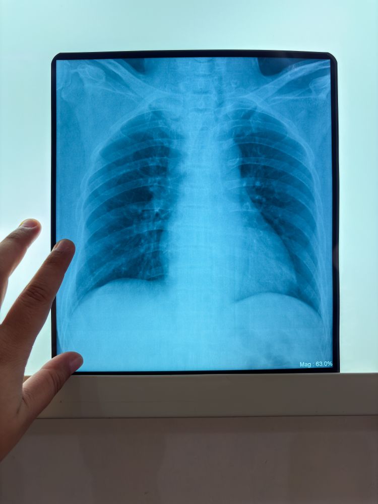Hand Holding Chest X-ray Film Showing Human Lungs