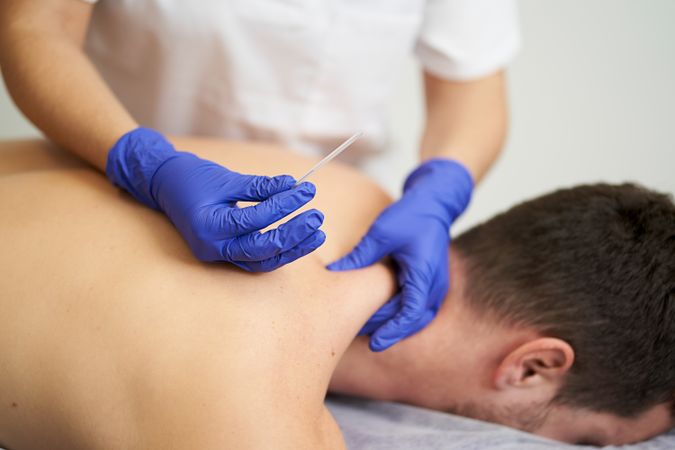 physiotherapist treating an overload with dry needling