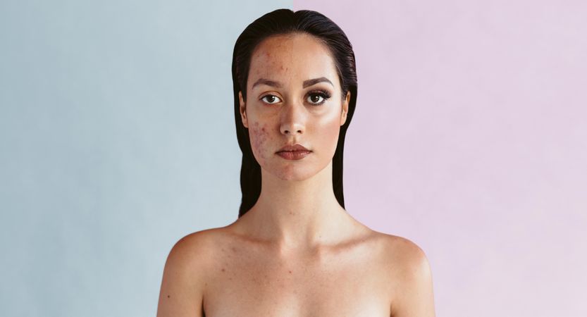 Contrasting before and after makeup face of a woman with acne problem