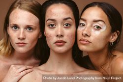 Young women with diverse skin disorders like freckles, acne and vitiligo 0JkMr5