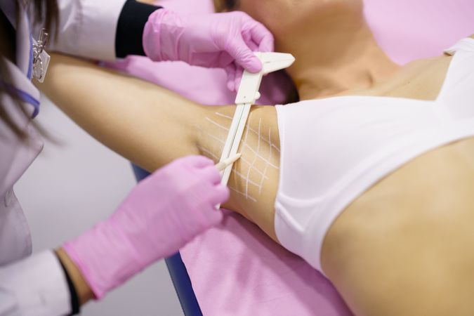 Woman having her underarm grafted for hyperhidrosis treatment
