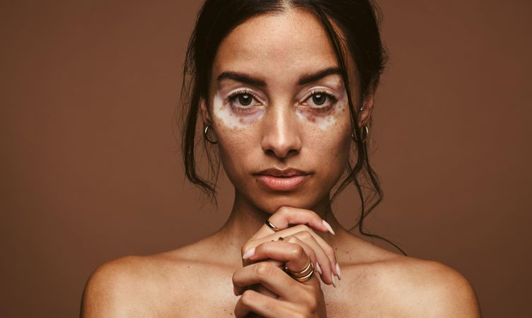 Close up of woman with vitiligo disorder around her eyes