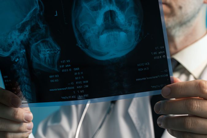 Doctor examining skull X-ray film