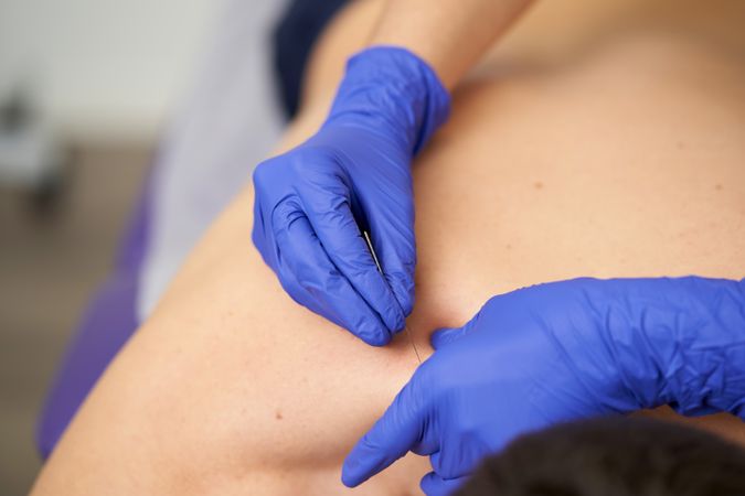 physiotherapist treating an overload with dry needling