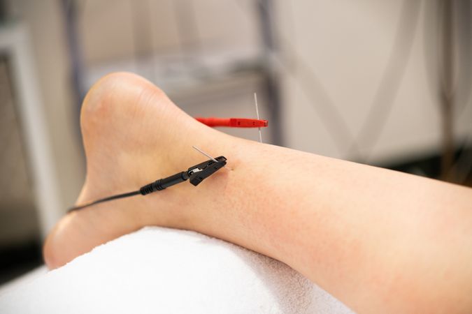 Ankle with two needles in it for electro acupuncture