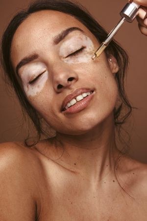 Woman undergoing treatment for vitiligo