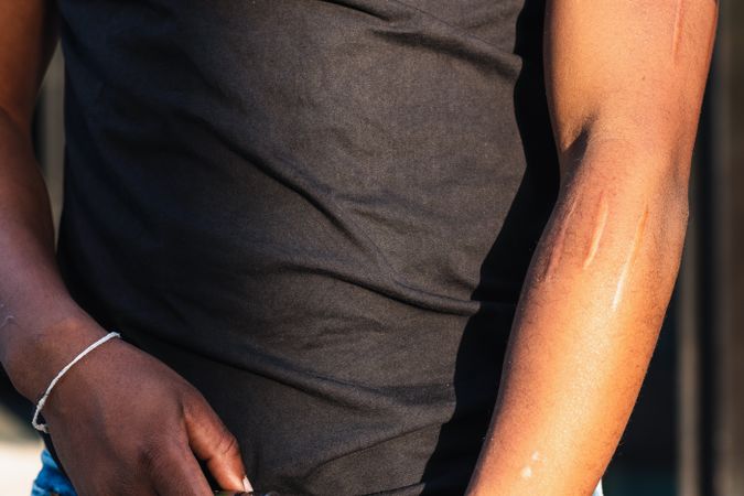 Faceless Black person with scars on arm