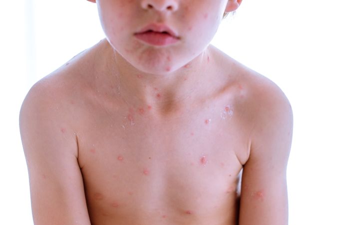 Crop child with varicella blisters