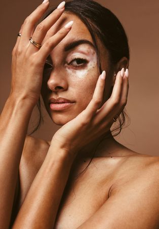 Young woman with vitiligo covering her face with her hands