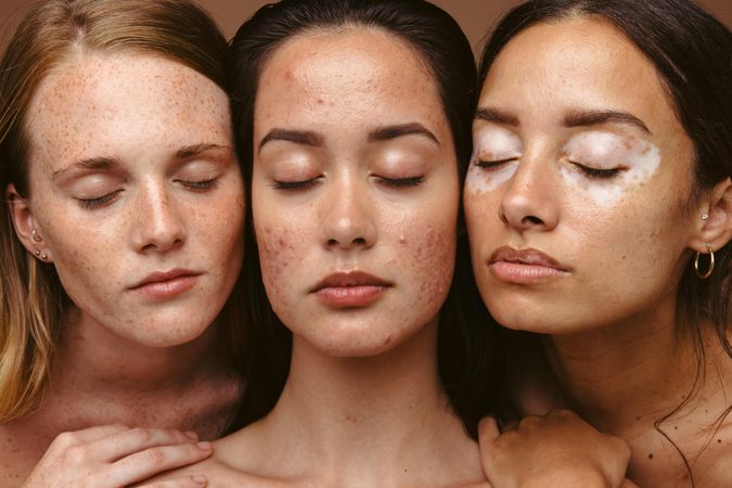 Three faces of women living with rare and common skin conditions