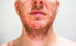Man with seborrheic dermatitis in the beard area