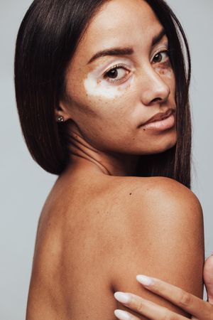 Side view portrait of a woman with vitiligo